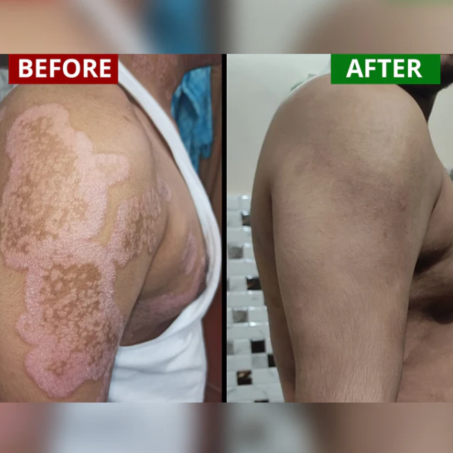 Psorio Amrit Syrup – आयुर्वेदिक त्वचा समाधान - Image 2